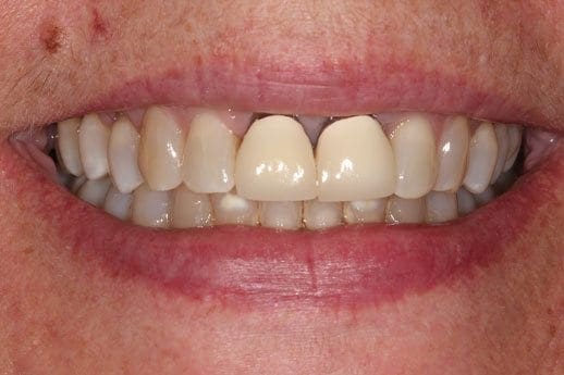laura-b-before