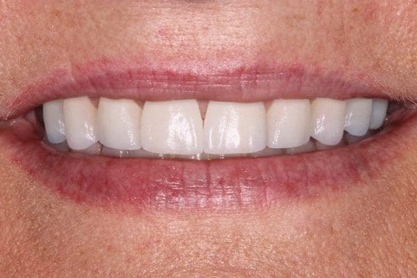 patient-b-after-600x400