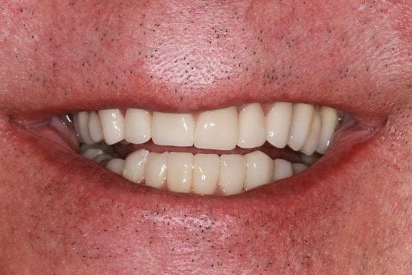 patient-f-after-1-600x400