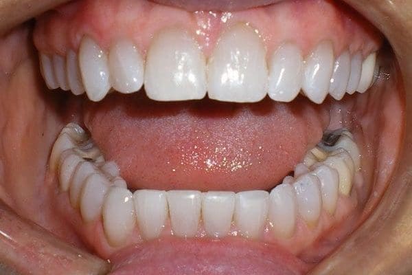 patient-f-after-600x400