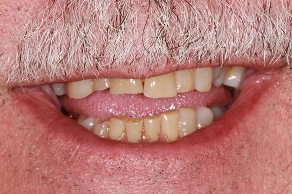 patient-f-before-1-600x400