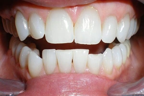 patient-f-before-600x400