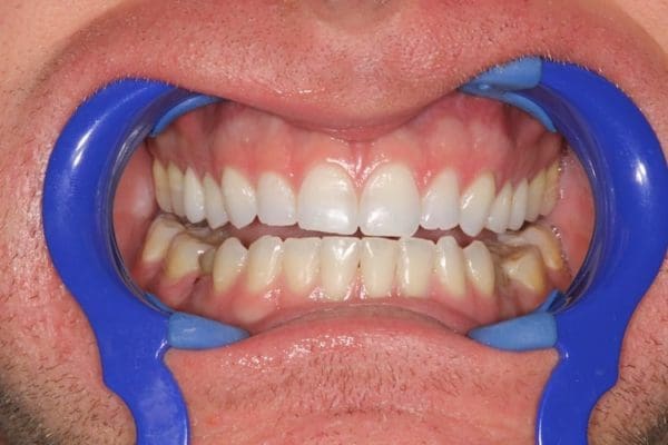 tooth-wear-before-600x400