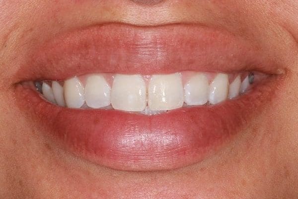 zoom-after-600x400