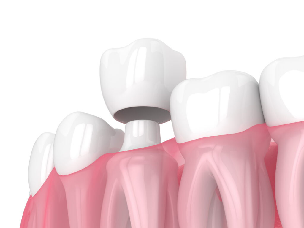 Dental Crown in Plano Texas