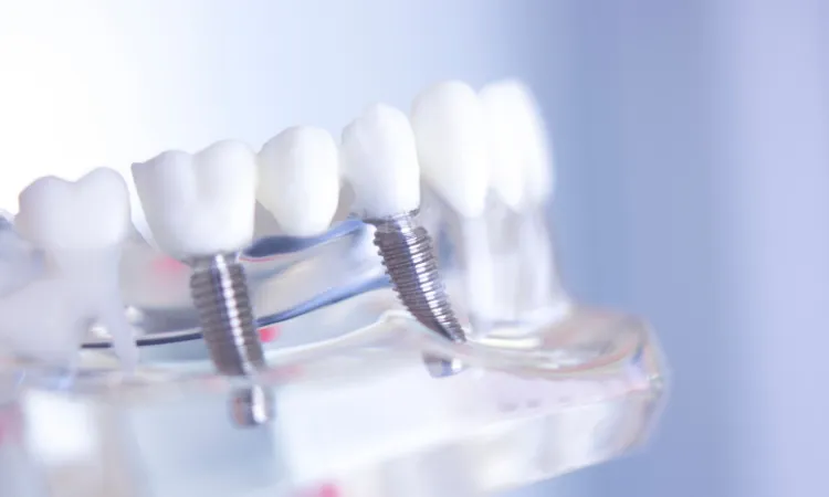 Dental Implants vs. Bridges: How to Choose in Plano, TX