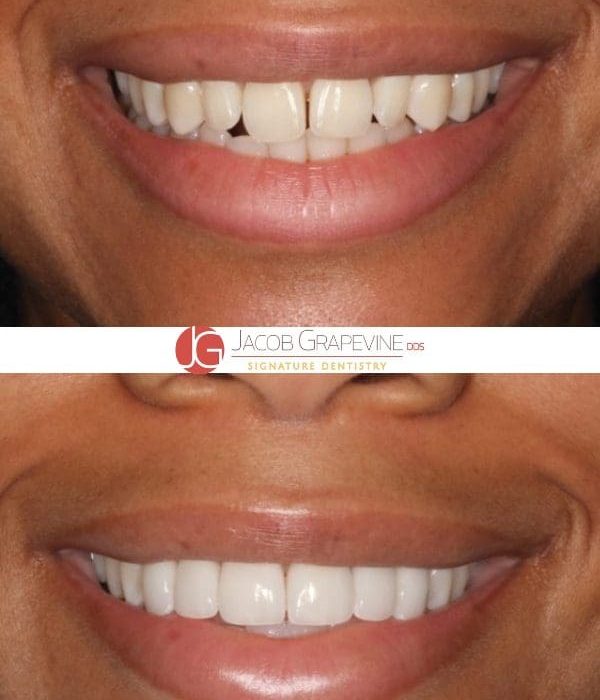 Grape Veneers (6)